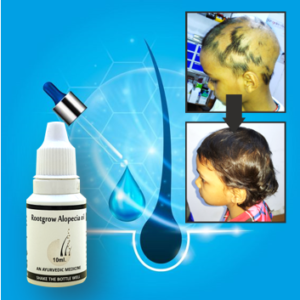 Alopecia Oil